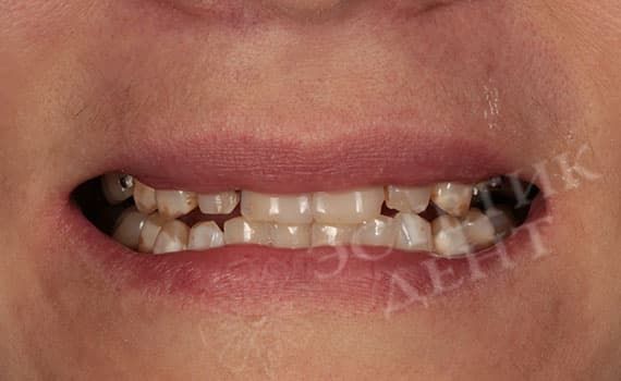 Поставить на зубы: виниры или люминиры До и после