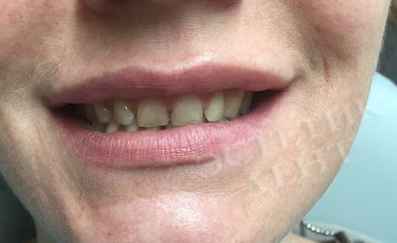 Поставить на зубы: виниры или люминиры До и после