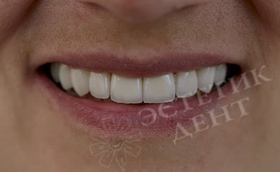Поставить на зубы: виниры или люминиры до и После