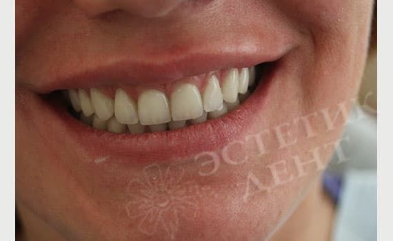 Поставить на зубы: виниры или люминиры до и После