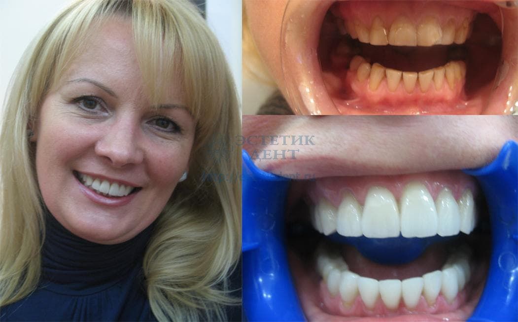 виниры на зубы москва фото до и после